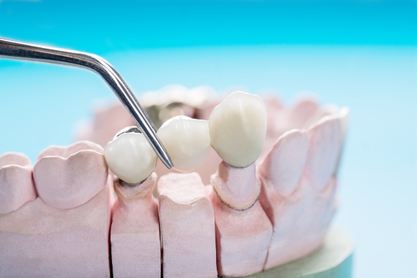 Dental Bridge Vs  Dental Crowns: What Is The Difference?