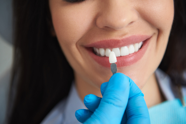 Who Is A Good Candidate For Veneers?