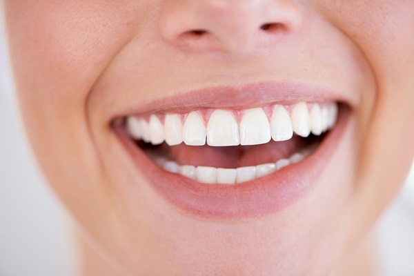 Professional Teeth Whitening Aftercare Tips